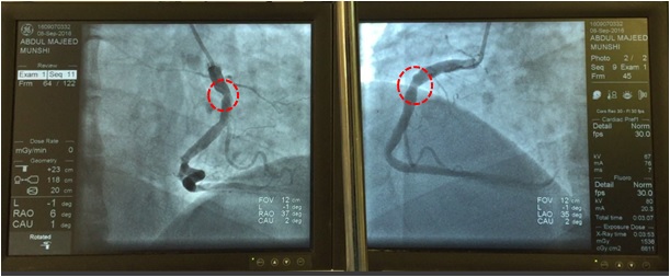 A blocked coronary artery from two view